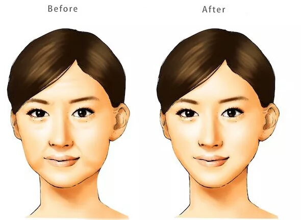 线雕后多久可以用射频仪,线雕后多久可以去美容院做脸