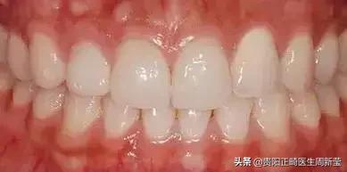 牙齿以前齐现在不齐是什么原因,牙齿排列整齐牙缝大前门牙凸
