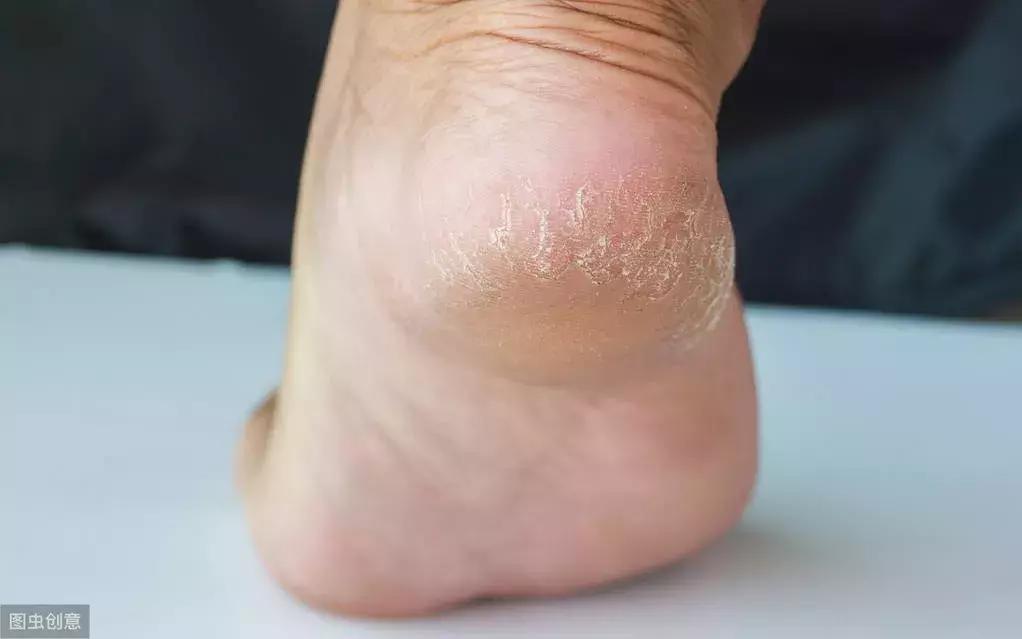 标婷手足霜功效,手足皲裂膏北京标婷