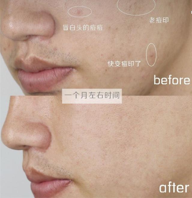 超棒国货去痘痘,祛除痘痘的国货测评