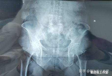 老年人腰痛慢性损伤怎么治疗 (老年人腰痛要怎么才能治好)