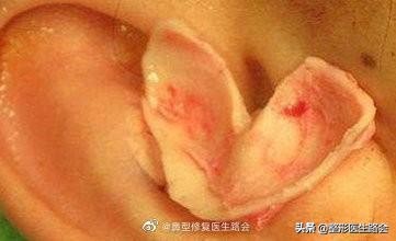 想去隆鼻,隆鼻到底值不值得入手