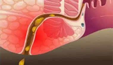 鑲涢棬鐤肩棝娴佽創鎬庝箞娌荤枟,鑲涢棬鍛ㄥ洿鐤肩棝娴佽創鎬庝箞娌荤枟