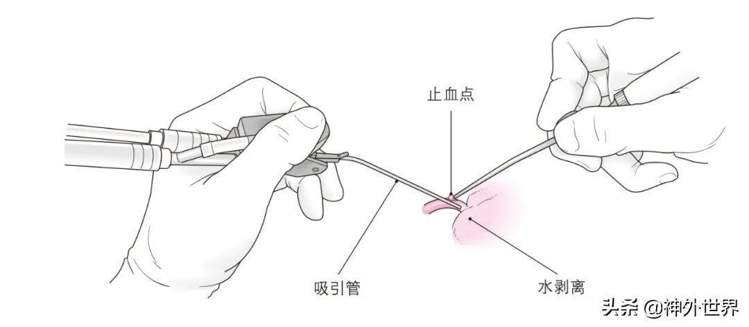 日本治神经损伤特效药,脑动脉炎症状与治疗
