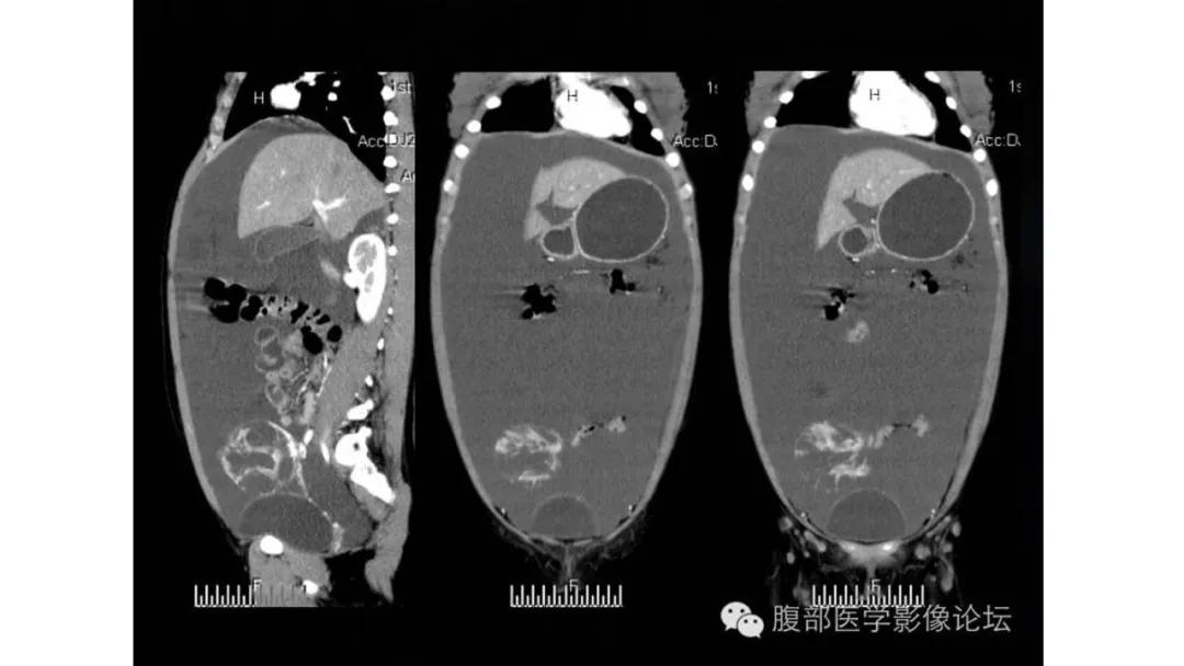 卵巢原发肿瘤的分析思路