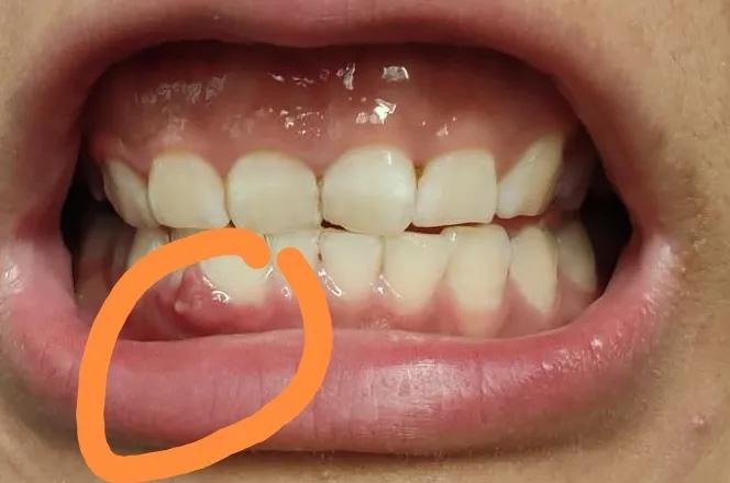 别让“上火”延误您保留牙齿的机会