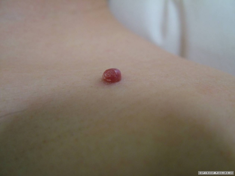 皮肤上长的红色像痣的是什么东西,头上长红色的肉痣是一种什么病吗