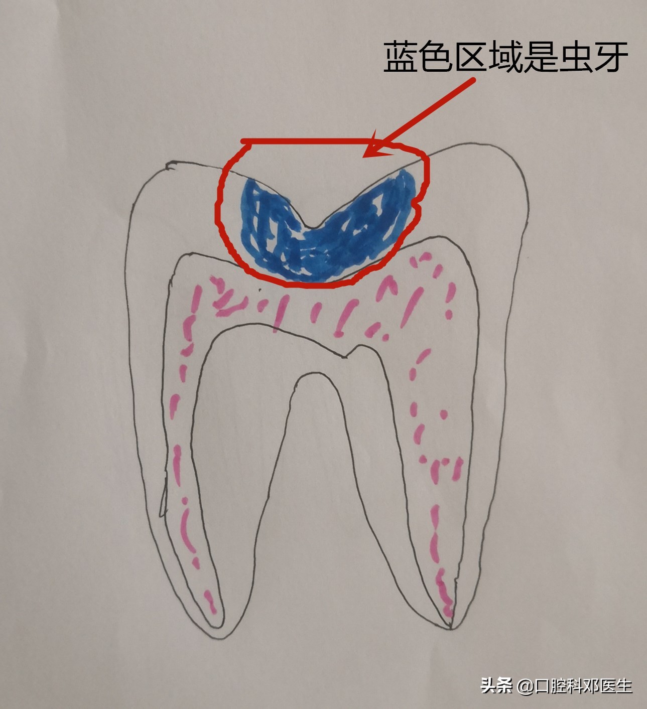 虫牙补牙方法有几种,虫洞露牙补牙的正确方法