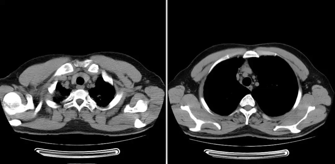 青年男性肺炎过后一直咳嗽怎么办,潜伏结核感染咳嗽咳痰