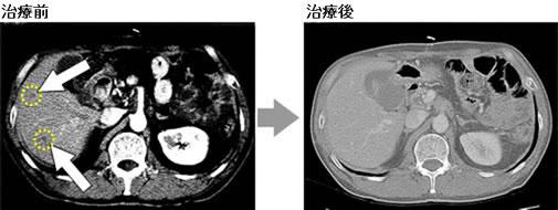 癌症治疗多面手！NK细胞免疫疗法，或将成为晚期癌症治疗最佳选择