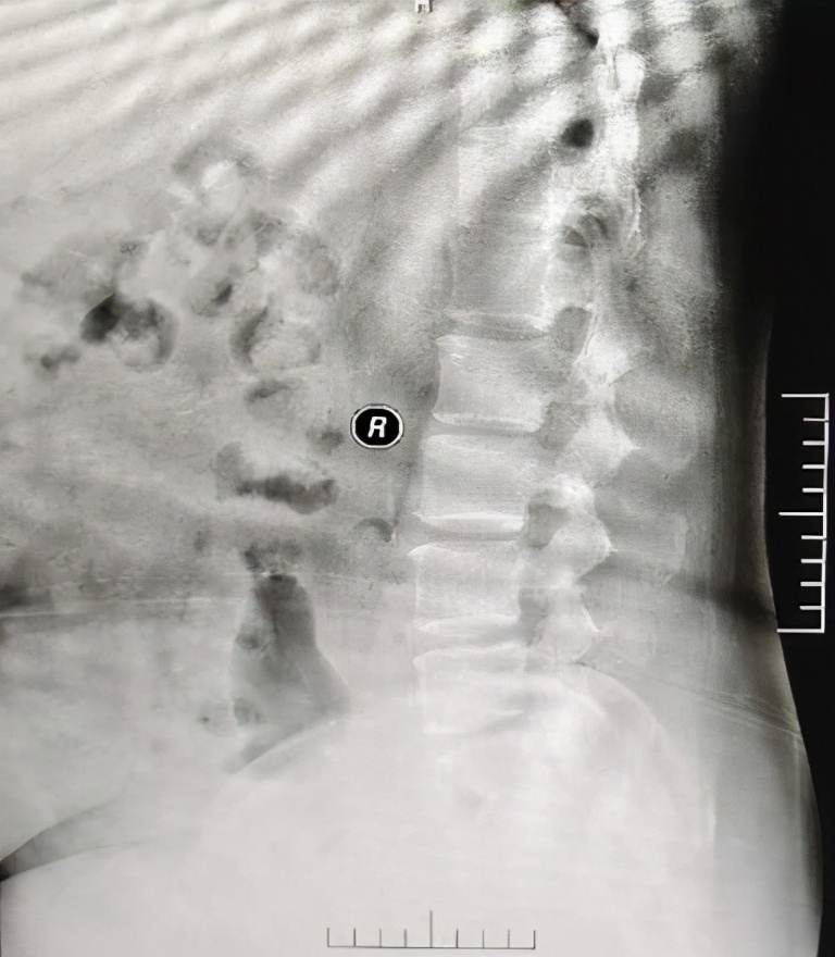 血液透析甲状旁腺素低好吗,高钙血症的血液透析