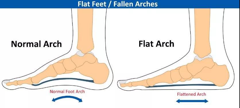 足弓塌陷会自己好吗,足弓塌陷恢复后腿会变细吗