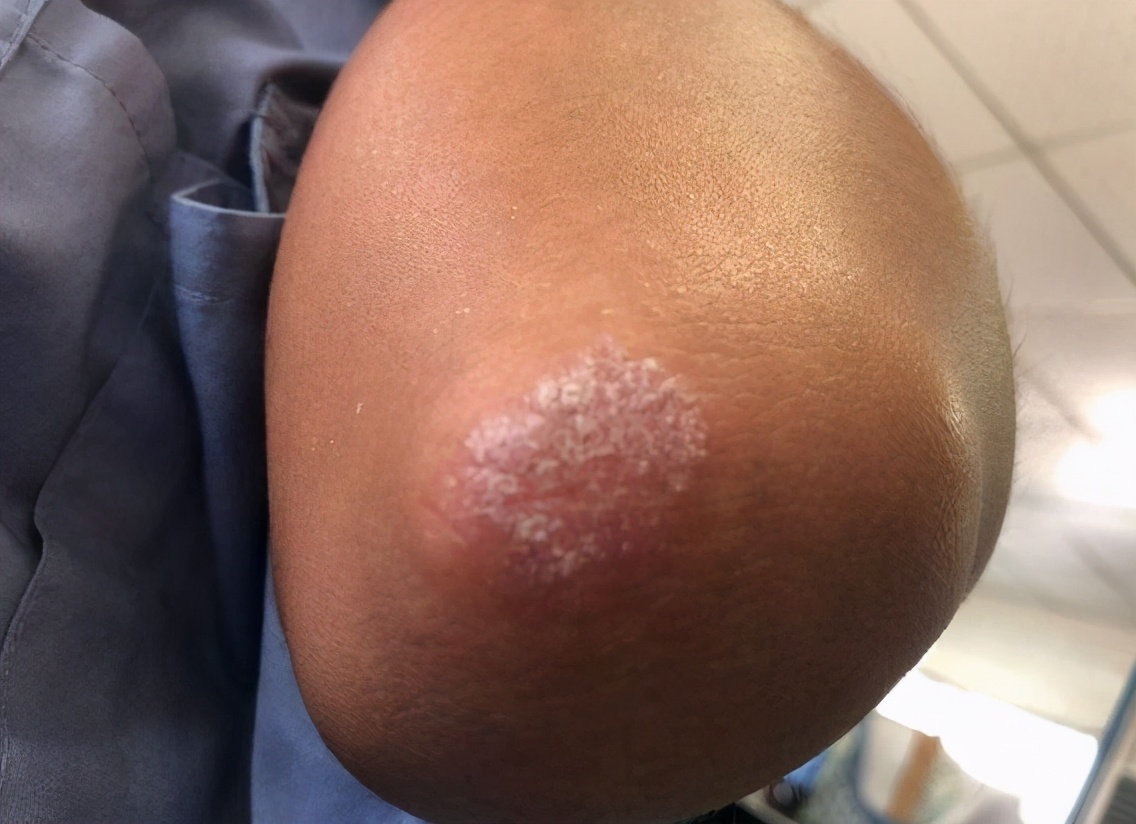 火疗引火烧身,引火归元针治疗三种病