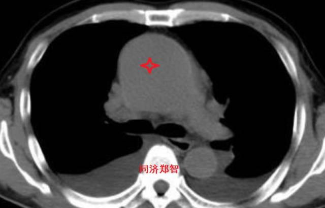 磁共振可以替代cta检查主动脉夹层,超声心动图联合cta诊断主动脉夹层