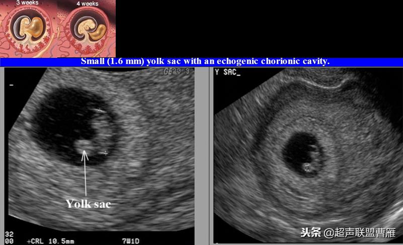 3毫米卵黄囊未见胎芽正常么,40多天的卵黄囊