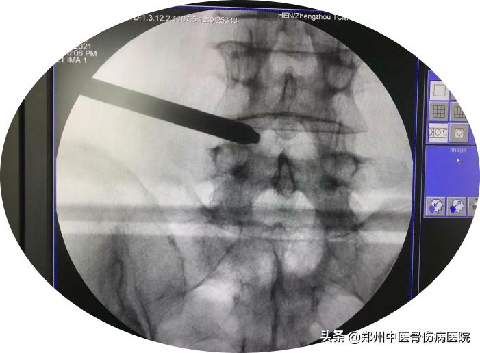 腰腿痛治半年多没效果,腰腿痛有做小针刀好的吗