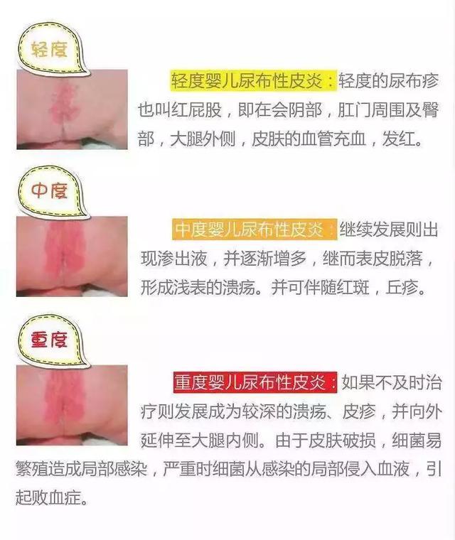 接触性皮炎的西医鉴别诊断,接触性皮炎怎么治疗才能彻底除根