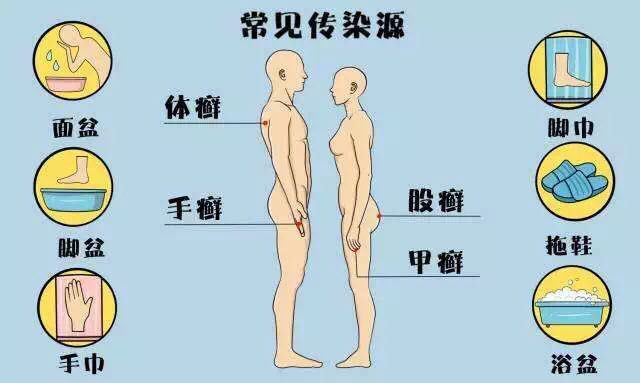 脚丫长脚气怎么治好的,脚丫上有脚气要怎么办