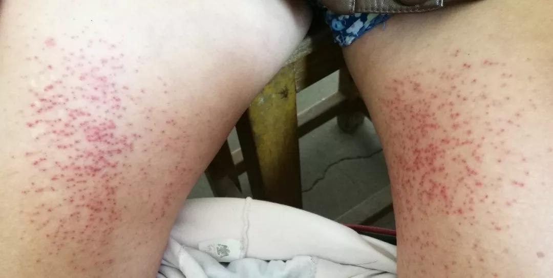 皮炎湿疹老反复发作该怎么根治,皮炎湿疹总是反复怎么办