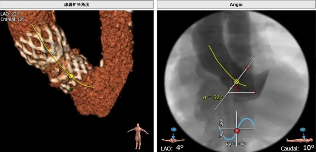 BAV遭遇心脏突然停跳，Sapien3快速植入挽救患者生命