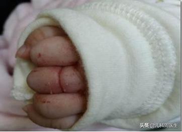 婴儿绕脖有什么危害,婴儿绕颈2圈有危险吗