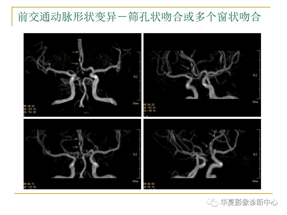 中国人脑立体定向mri应用解剖图谱,脑mri示意图