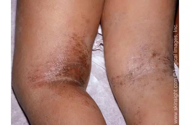 宝宝身上红点点是湿疹么,宝宝起湿疹和热痱子怎么区分