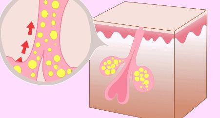毛孔粗大皮肤粗糙怎么办,男生毛孔粗大毛孔粗糙怎么办