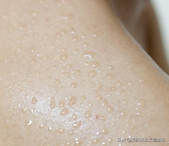 汗斑是皮肤炎症引起的吗,皮肤得了汗斑怎么治好