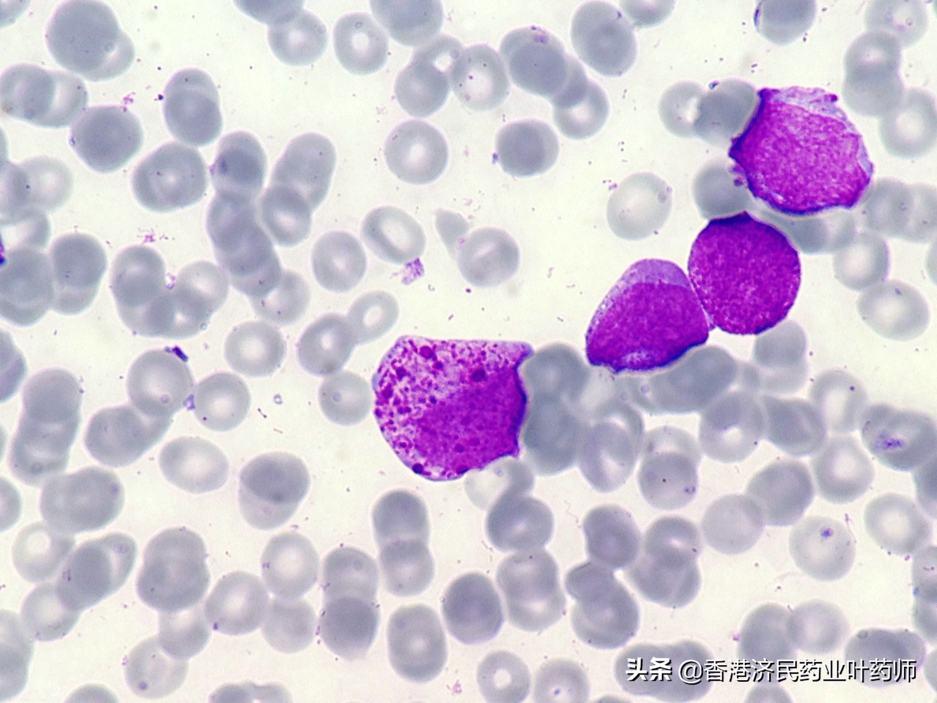 EC批准Minjuvi+来那度胺治疗复发性或难治性弥漫性大B细胞淋巴瘤