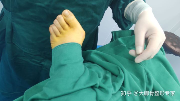 大脚骨判断标准,大脚骨自测方法