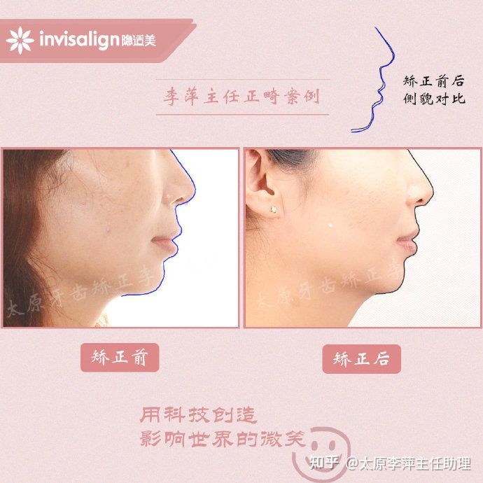 重度拥挤矫正牙齿适合隐形牙套吗,广州成人牙齿矫正推荐隐形牙套