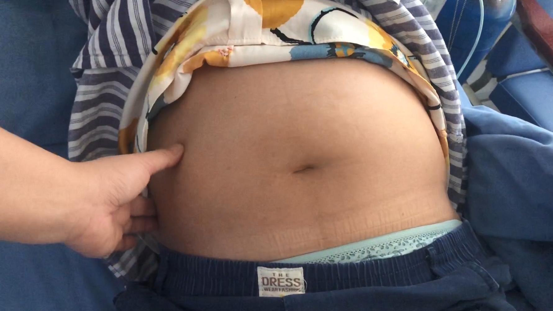 甲亢致人死亡,甲亢实际案例