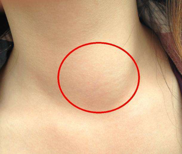 灵枢易针单纯性甲状腺肿大患者的福音——宏世堂今日干货分享