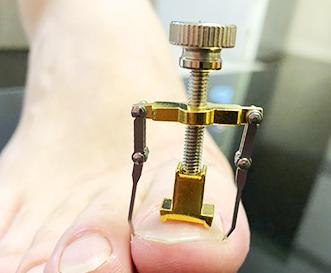 脚气如何根治图片,脚气病治疗好办法