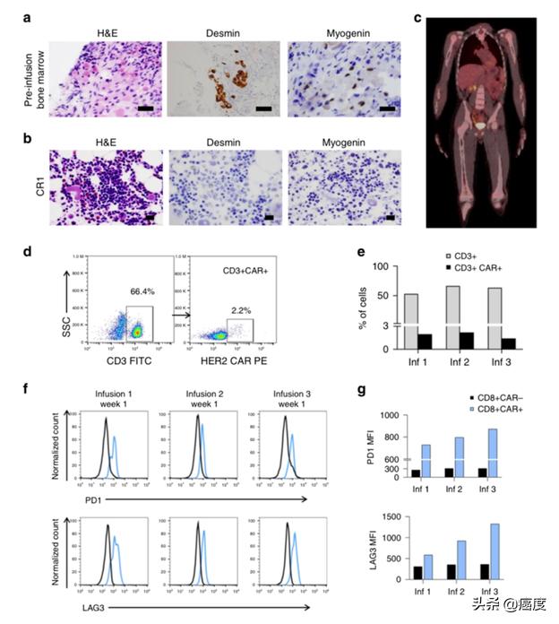 7岁横纹肌肉瘤患儿康复，CAR-T细胞疗法这么神奇吗？