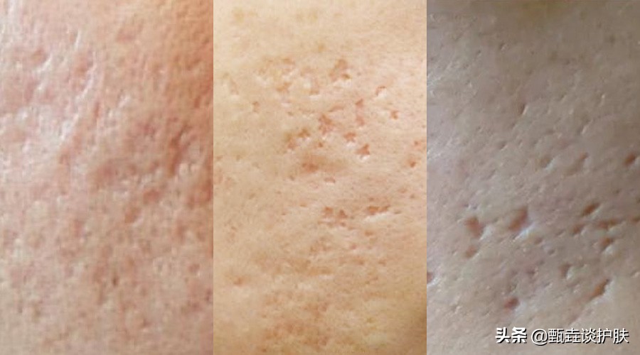 脸上小痘坑怎么修复,痘坑到底能不能修复