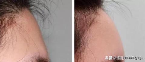 自体脂肪填充量有标准吗,自体脂肪填多了可以取出吗