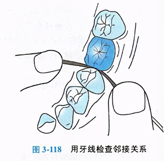 牙齿缺损粘接修复术和简单填充术,牙科义齿修复零基础教学