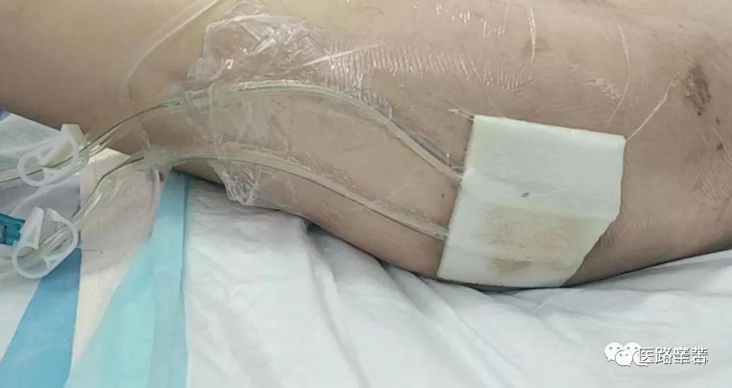 微创伤口换药步骤,如何换药包扎伤口