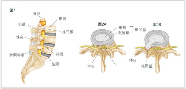 出现下肢麻木、运动无力，就是腰间盘突出症？医生：那可不一定