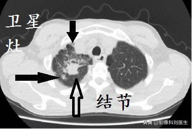 肺结核和肺癌的ct怎么鉴别,肺结核的ct鉴别诊断