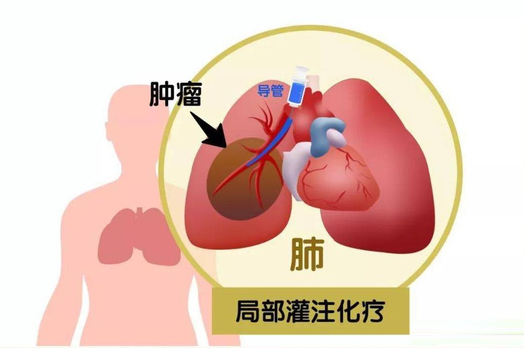 肿瘤介入微创疗法要多少钱,微创治疗肿瘤有哪些手段