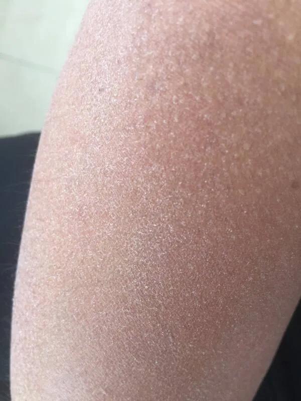 腿的皮肤有鱼鳞纹怎么回事,腿上长了像鱼鳞一样的皮肤