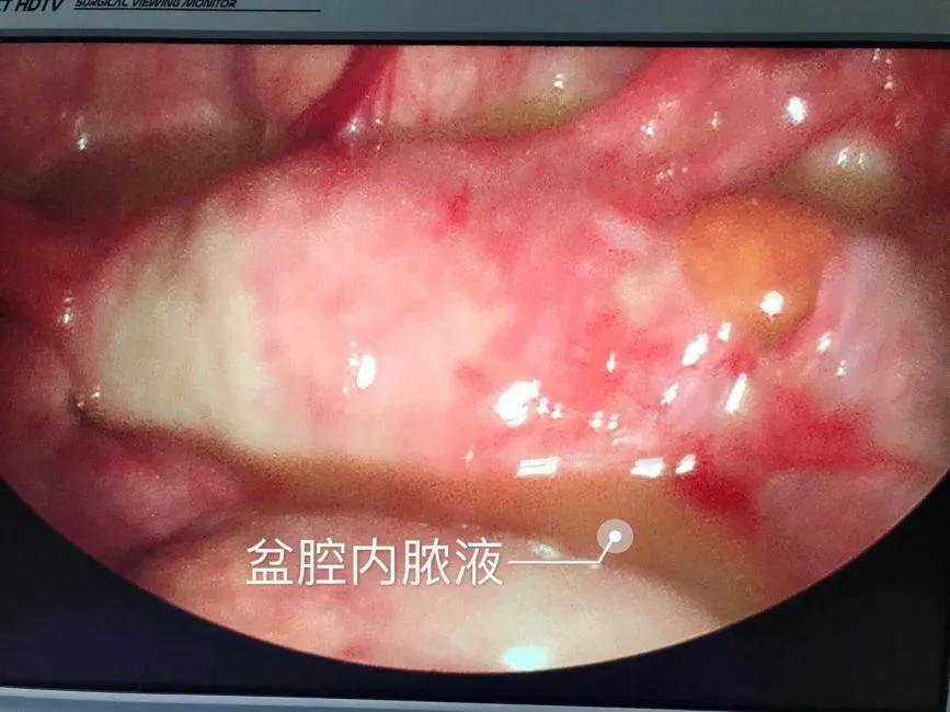 急性盆腔脓肿早期最佳治疗,盆腔脓肿的手术指征