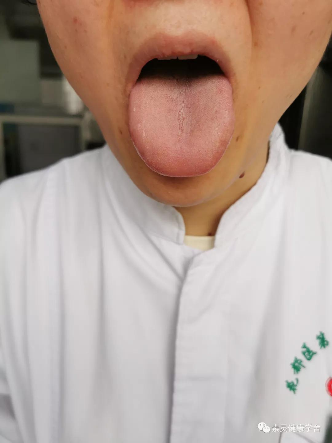 肝功检测异常,脐灸治疗肝脏视频