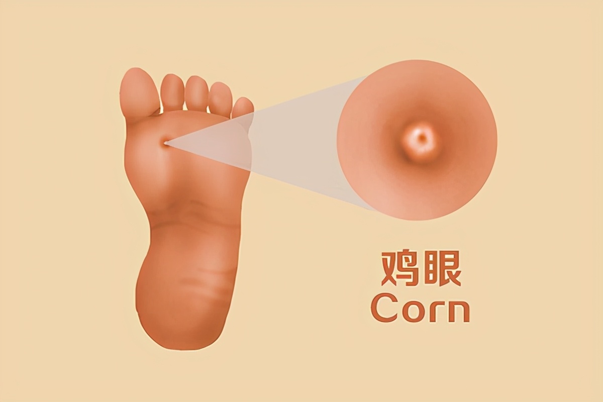 脚上长了很多鸡眼怎么解决,脚上长了鸡眼有什么办法处理断根