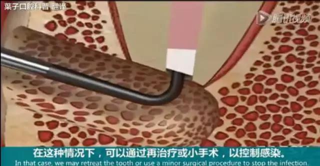 牙龈反复鼓包流脓是牙齿坏了吗,一上火牙龈就鼓包