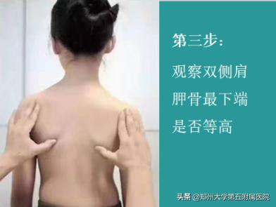 郑大五附院脊柱侧弯儿童专家,郑大一附院脊柱弯曲康复科