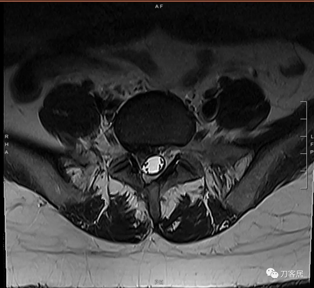 椎间孔镜微创手术13天,椎间孔镜微创手术患者